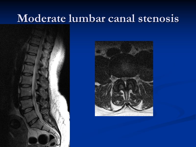 Moderate lumbar canal stenosis